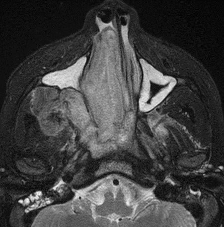 daniel_gewolb's tweet image. ⭐️ Classic case: what’s the most likely diagnosis in this 12 y/o M presenting with stuffy nose and epistaxis?

#ENT #Peds #medicine #radres #futureradres #Neurology #neurosurgery @ASHNRSociety @Radiopaedia