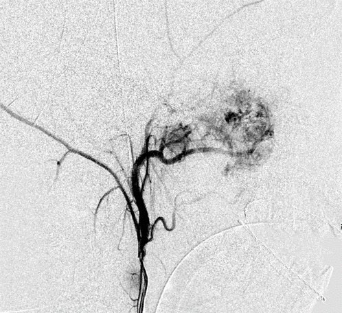 daniel_gewolb's tweet image. ⭐️ Classic case: what’s the most likely diagnosis in this 12 y/o M presenting with stuffy nose and epistaxis?

#ENT #Peds #medicine #radres #futureradres #Neurology #neurosurgery @ASHNRSociety @Radiopaedia
