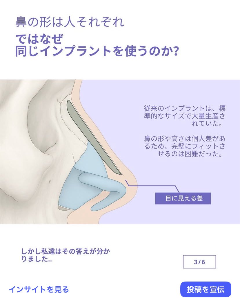 JWSurgeryKorea's tweet photo. ジョンウォン整形外科のインナーフィット鼻整形とは？？

ご連絡はこちらまで💁‍♀️日本語🆗✨:
english@jwbeauty.net

👉もっと多くのレビューをチェックしてみてください: #jwkorea_review

➡️無料オンライン相談:

👉https://t.co/rms0eLwm3j

📧メール: english@jwbeauty.net

💚LINE: jwpsjp

💬WhatsApp:

010-7195-5114

010-6389-5114

010-4779-5116

010-5768-5114

#jwジョンウォン整形外科 #韓国整形外科 #整形外科 #韓国おすすめ #手術後 #二重整形　#埋没 #ビフォーアフター  #整形レポ #江南 #渡韓整形 #韓国好きな人と繋がりたい #Jwplasticsurgery #モデル募集 #無料