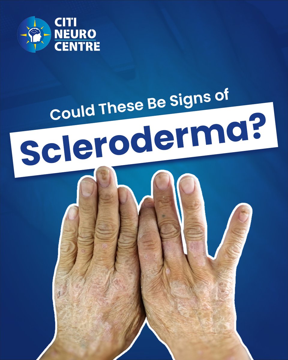 citineurocentre's tweet image. Is your skin trying to tell you something?
Unusual changes in your hands or joints, or discomfort while eating, might be more than just routine signs of aging. 
#SclerodermaAwarenessmonth #Sclerodermaawareness #Raredisease #chronicillness #KnowTheSigns #CNCHospitals