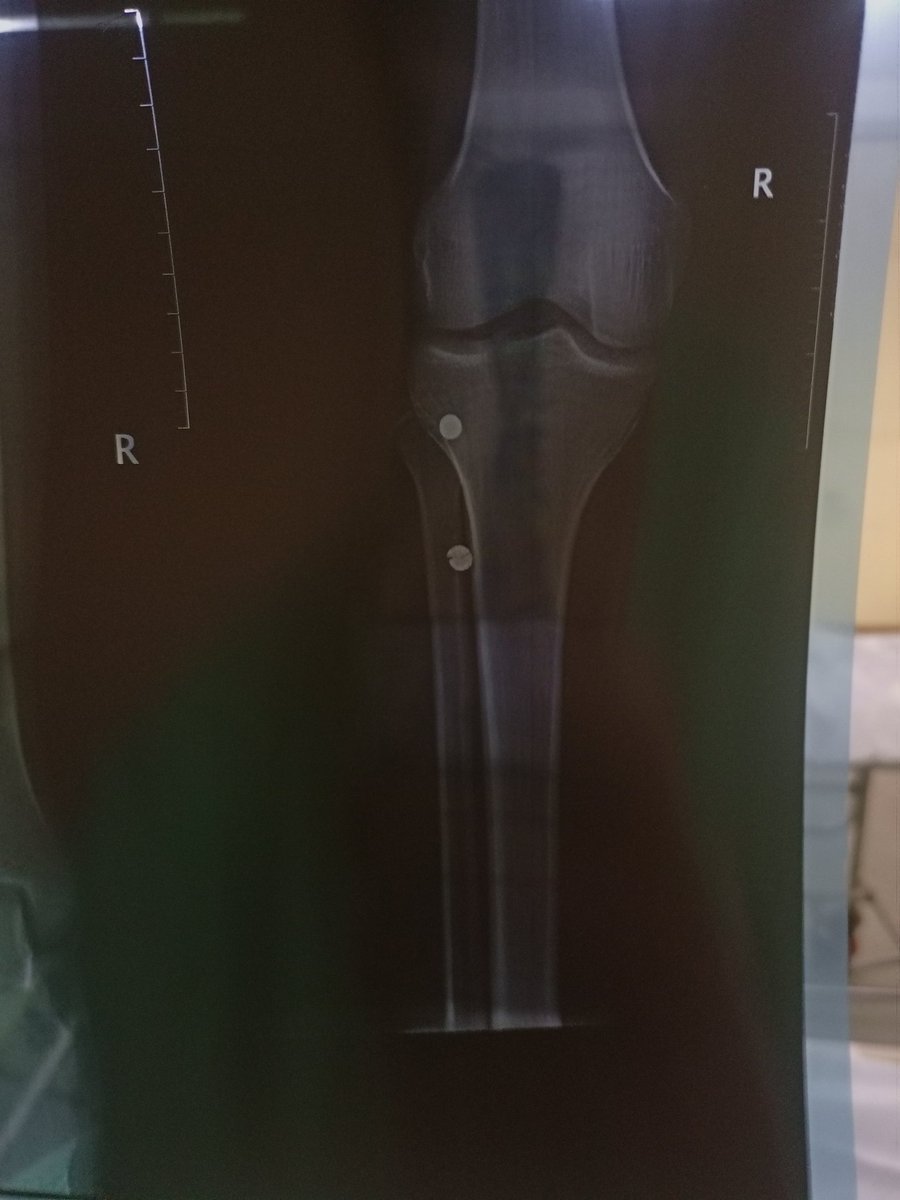 <a href="/Kibet_bull/">Yoko</a> Some of us are yet to get treatment 

Two bullets right leg

Shot on 25th

#FreeNdianguiKinyagia