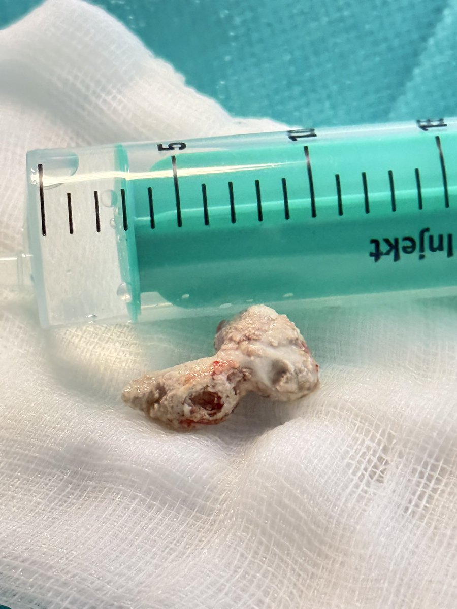 This is not a coral 🪸 🧐
Extracted from the pancreatic duct in a patient with acute on chronic #pancreatitis with this beauty right behind the ampulla. 
#GItwitter #GIX #MedTwitter