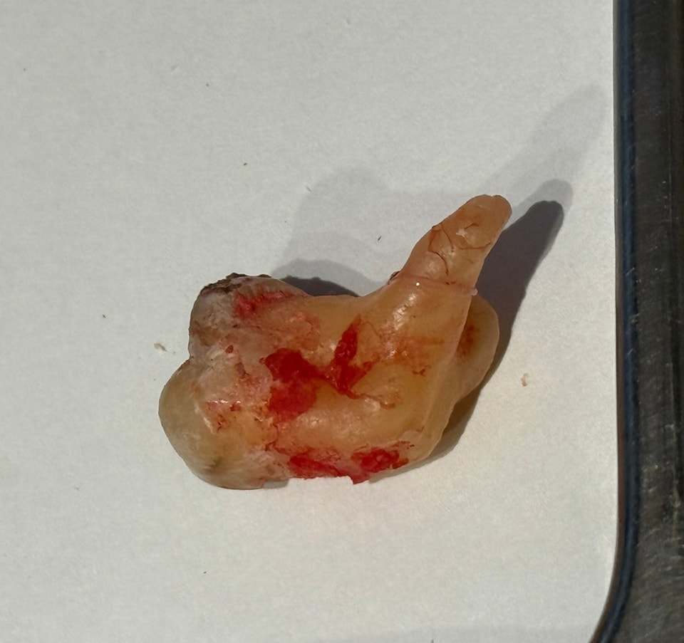 這執業17年來
各種詭異的牙齒看了不知道多少
但是
這麼惹人討厭形狀的牙齒
還算是這十年來第一次看到

我決定要命名這顆牙叫做 
「中指芯」