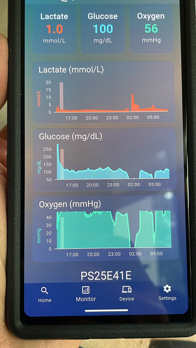Howard Luks MD (@hjluks) on Twitter photo Continuous lactate day 1.
Multianalyte sensor by <a href="/Percusense/">PercuSense Inc.</a> - reach out. They want to hear from you.
Lactate has been stable
Glucose is stable
Oxygen channel isn’t calibrated well yet.
That blip in the night was likely me lying on the sensor.
Lactate might be the best Continuous lactate day 1.
Multianalyte sensor by <a href="/Percusense/">PercuSense Inc.</a> - reach out. They want to hear from you.
Lactate has been stable
Glucose is stable
Oxygen channel isn’t calibrated well yet.
That blip in the night was likely me lying on the sensor.
Lactate might be the best