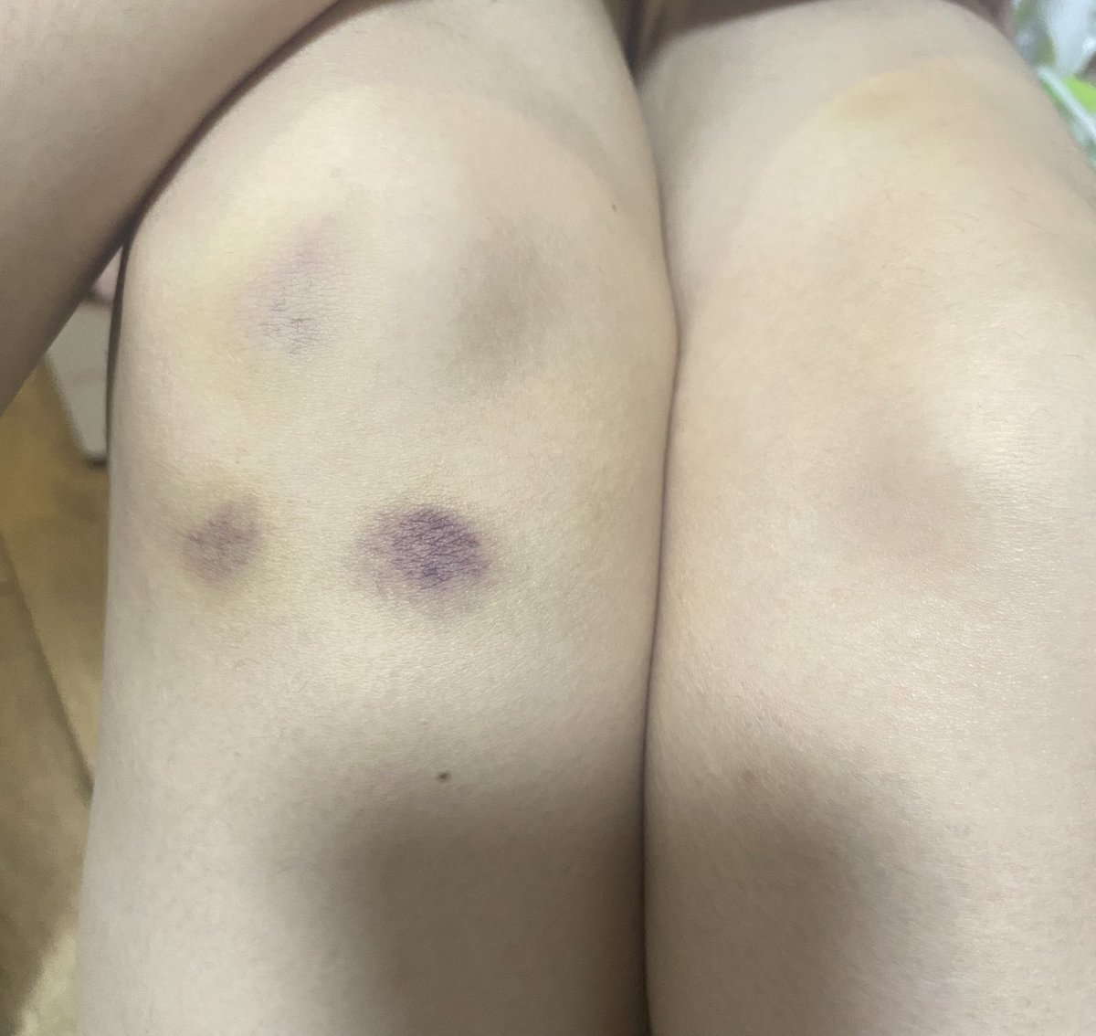 不明白这些青一块紫一块的到底是从哪磕到的，我自己根本没感觉。。