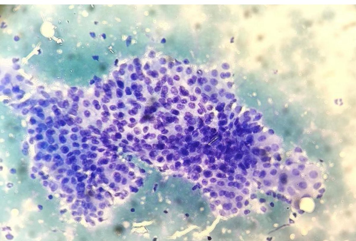 Cytolovers worldwide: Latest <a href="/CytologyEFCS/">EFCS</a> is ready! The case of the month by <a href="/pietro_tralongo/">Pietro Tralongo</a> will surely catch your attention! Don’t miss it! Click here ↪️ efcs.eu/case-of-the-mo… 🇮🇹🔬 #cytopath #cytology #FNA