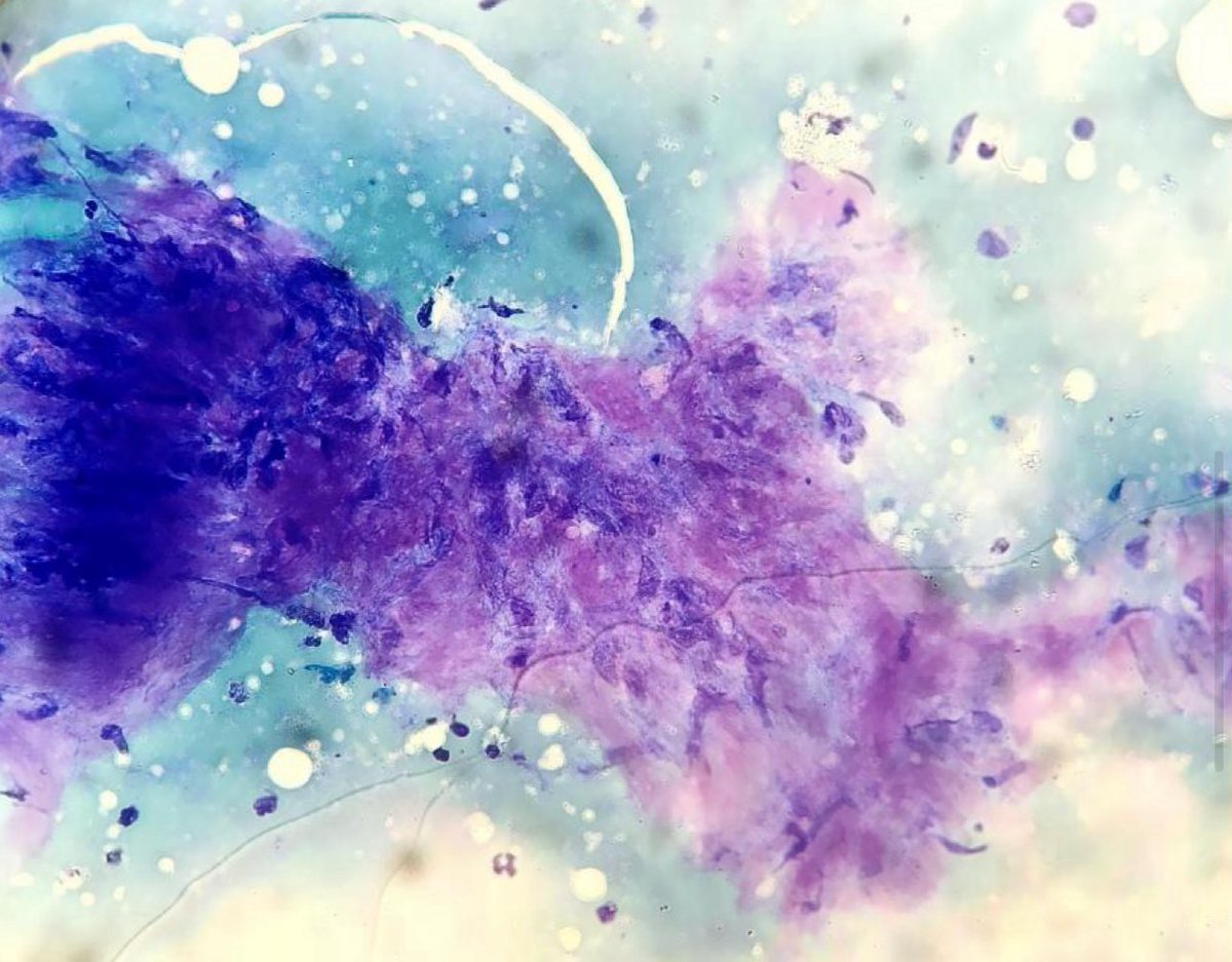 EfcsYoung's tweet photo. Cytolovers worldwide: Latest @CytologyEFCS is ready! The case of the month by @pietro_tralongo will surely catch your attention! Don’t miss it! Click here ↪️ https://t.co/9a5kuee87l 🇮🇹🔬 #cytopath #cytology #FNA https://t.co/X8MHQI6meV