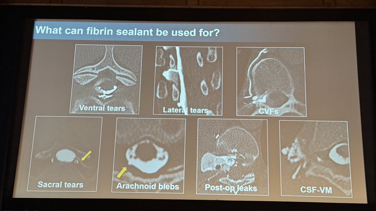 MarkMamloukMD's tweet image. On the first day of the international SIH leak conference in Amsterdam, @NeuroradLal highlights the role of targeted patching for the various types of CSF leaks.