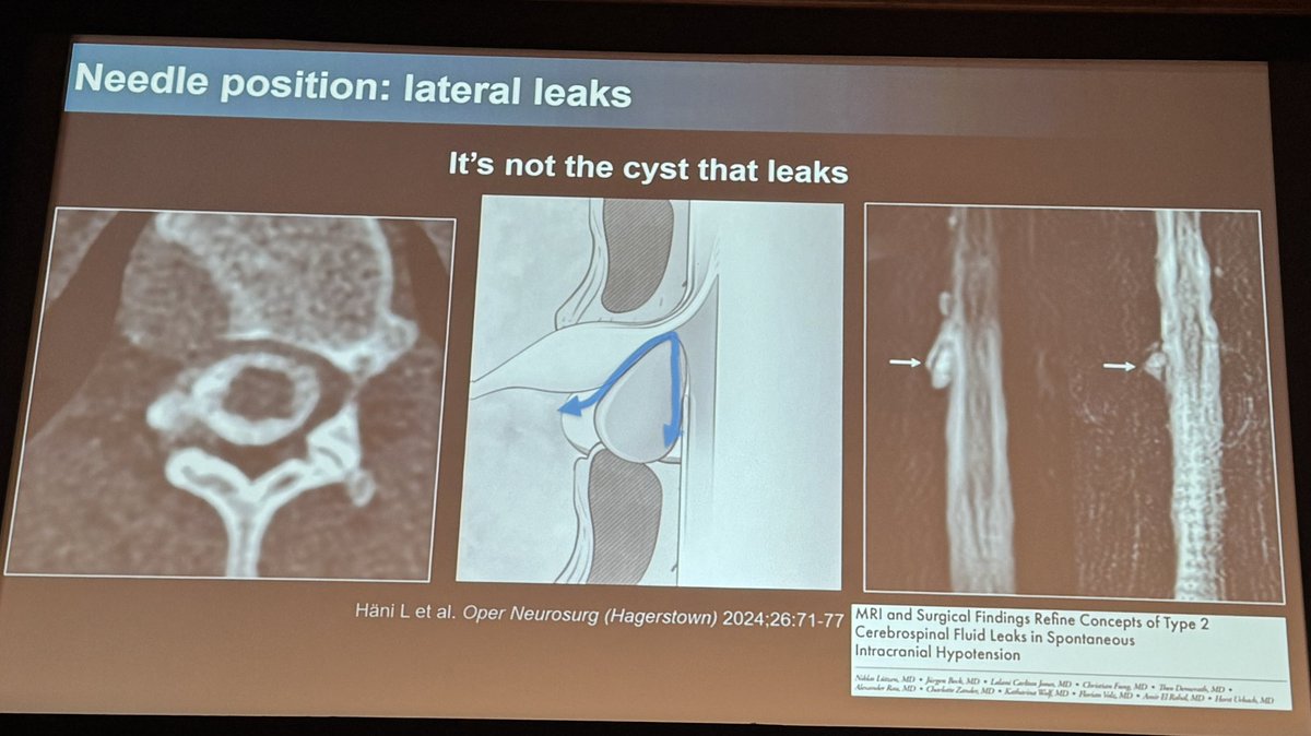 MarkMamloukMD's tweet image. On the first day of the international SIH leak conference in Amsterdam, @NeuroradLal highlights the role of targeted patching for the various types of CSF leaks.
