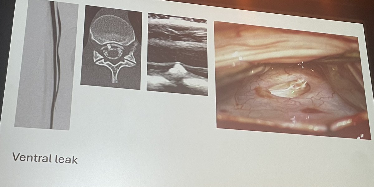 Peter Kranz (@petergkranz) on Twitter photo <a href="/WouterSchievink/">WouterSchievink</a> , a figurative giant in the field of #SIH, presents on surgical treatment of spinal CSF leak. #SIH #GPB at Amsterdam CSF leak conference <a href="/WouterSchievink/">WouterSchievink</a> , a figurative giant in the field of #SIH, presents on surgical treatment of spinal CSF leak. #SIH #GPB at Amsterdam CSF leak conference