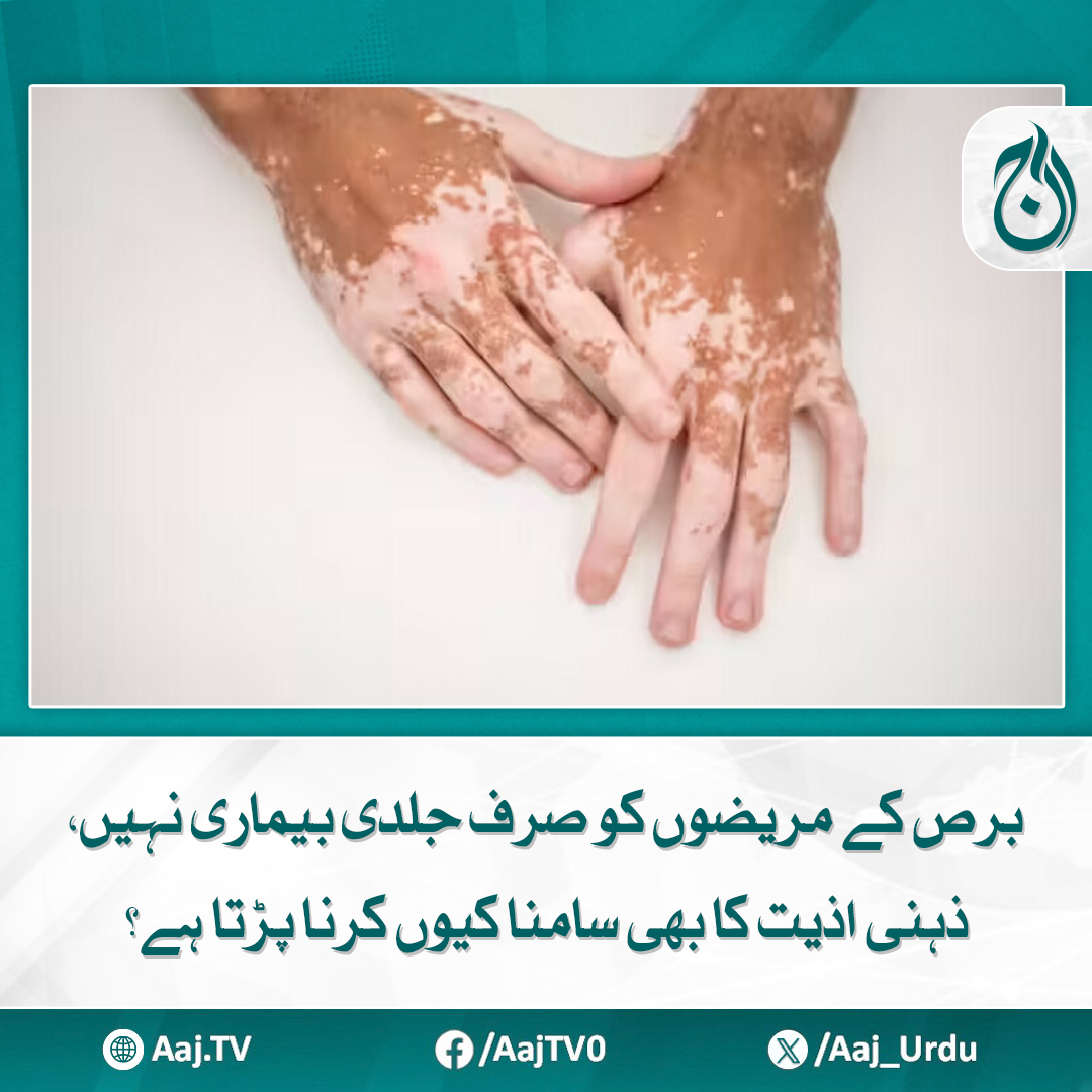 Aaj_Urdu's tweet photo. خوش قسمتی سے جدید سائنس میں برص کے علاج کے لیے نئی راہیں کھل رہی ہیں
مزید پڑھئے: https://t.co/1A2QzQRHzO
#AajNews #VitiligoAwareness #SkinCondition #MentalHealth https://t.co/XrlVt29BU4
