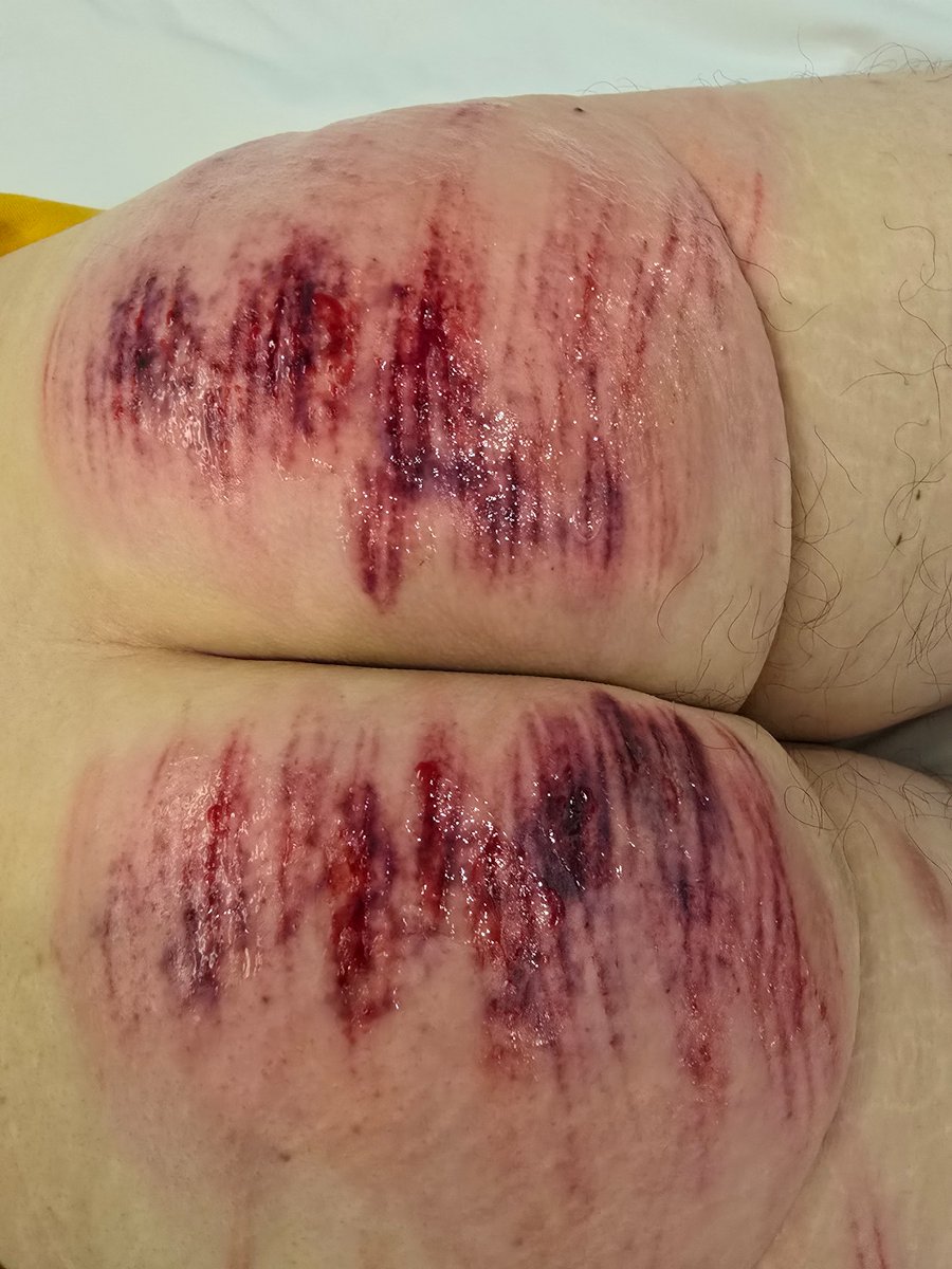 작년에 플하셨던 키 분과 1년여만에 다시 일플을 했습니다. 맷집도 좋으시고 반응도 좋아서 매우 만족스러운 플이였고, 덤으로 첫짤에 보이는 해외산 고급 케인까지 선물로 주신 ㄷㄷ다시 플하는 그 날까지 열심히 닦아놓겠(?) 습니다😋 #케인 #멜투멜 #스팽 #스팽킹 #일플 #체벌