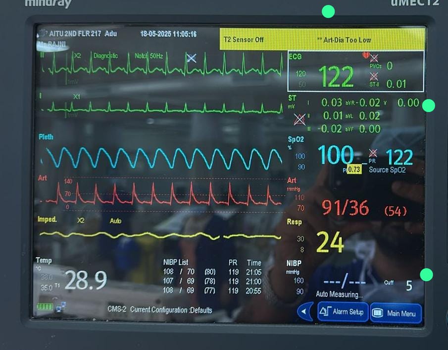 drvimalzenICU's tweet image. 🫀 **When Pulse Pressure Misleads… Trust the Contours**
A patient with *normal pulse pressure*, but VTi :9.5. The linearity of Pulse pressure to stroke volume breaks down in states with altered vascular tone
#Hemodynamics #PulsePressure #BeyondTheNumbers #PhysiologyFirst