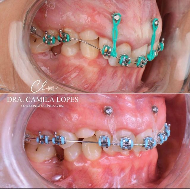 OviDentalGo's tweet photo. 🚫 Mini-implants: a game-changer in Orthodontics

They allow precise tooth movement, prevent side effects, and speed up complex treatments. A true blessing in advanced cases!

#Ovidental #OrthodonticAnchorage #MiniImplants #AdvancedOrthodontics #ClinicalOrthodontics #Orthodontics