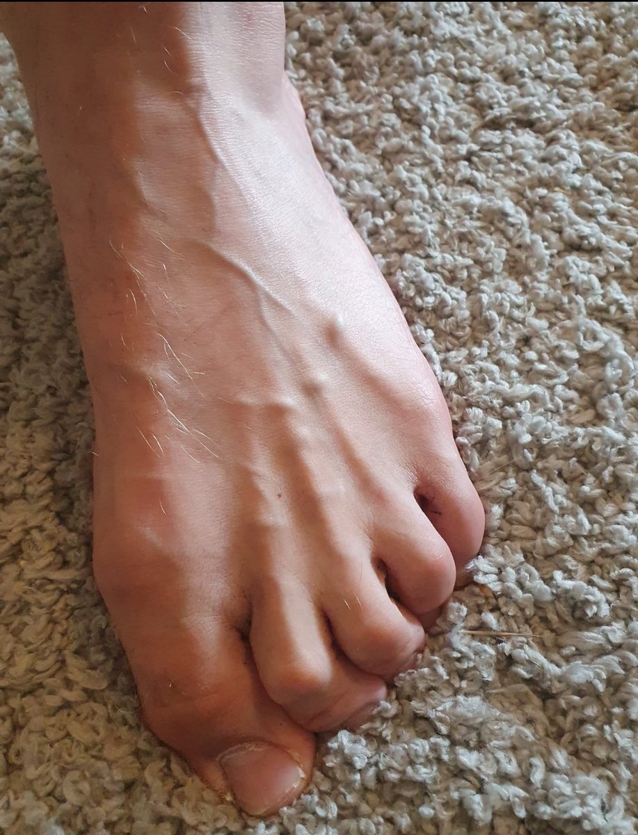 nickblackwell02's tweet image. My Paralysed Toes and Foot are getting worse thankfully the Drs have refered me to a specialist as it really impacts my balance and it gets painful and uncomfortable.
I can't feel anything and my toes are starting to claw under my foot. 😔 Joys of Brain Recovery.....…
