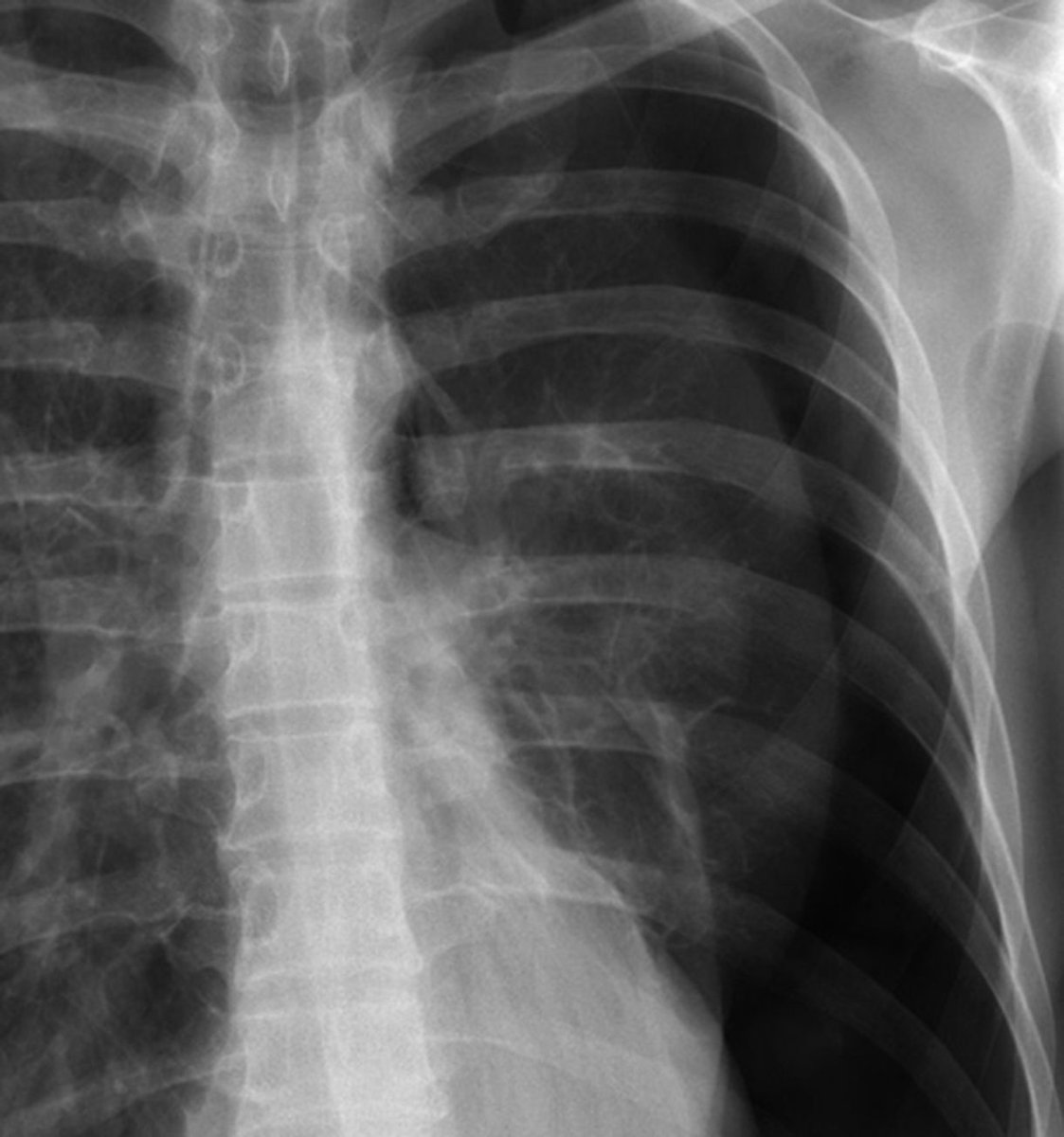 CHEST X-RAY 14: Chest pain and short of breath. What is the abnormality? Answer buff.ly/3WkNb6B
