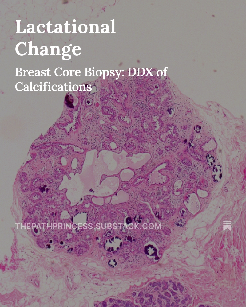 Lactational Change! A less common but unique finding associated with calcifications. 👇

thepathprincess.substack.com/p/lacational-c…

#breastpath #breastpathology #pathology #pathologists #pathTwitter #medicaleducation