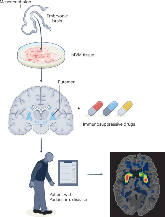 doctorveera's tweet image. Transplanting dopaminergic neurons-enriched fetal midbrain into adult brains for the treatment of Parkinson's disease. The transplant didn't benefit clinically, but it blows my mind that it's possible to do with safely without major adverse events.
Ref:
Vivian Tabar. A trial of…