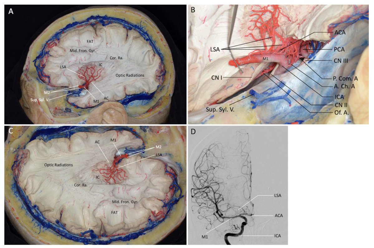 #OnlineFirst: Microsurgical anatomy of the fiber tracts and vascular structures lateral to the internal capsule. 

thejns.org/view/journals/…