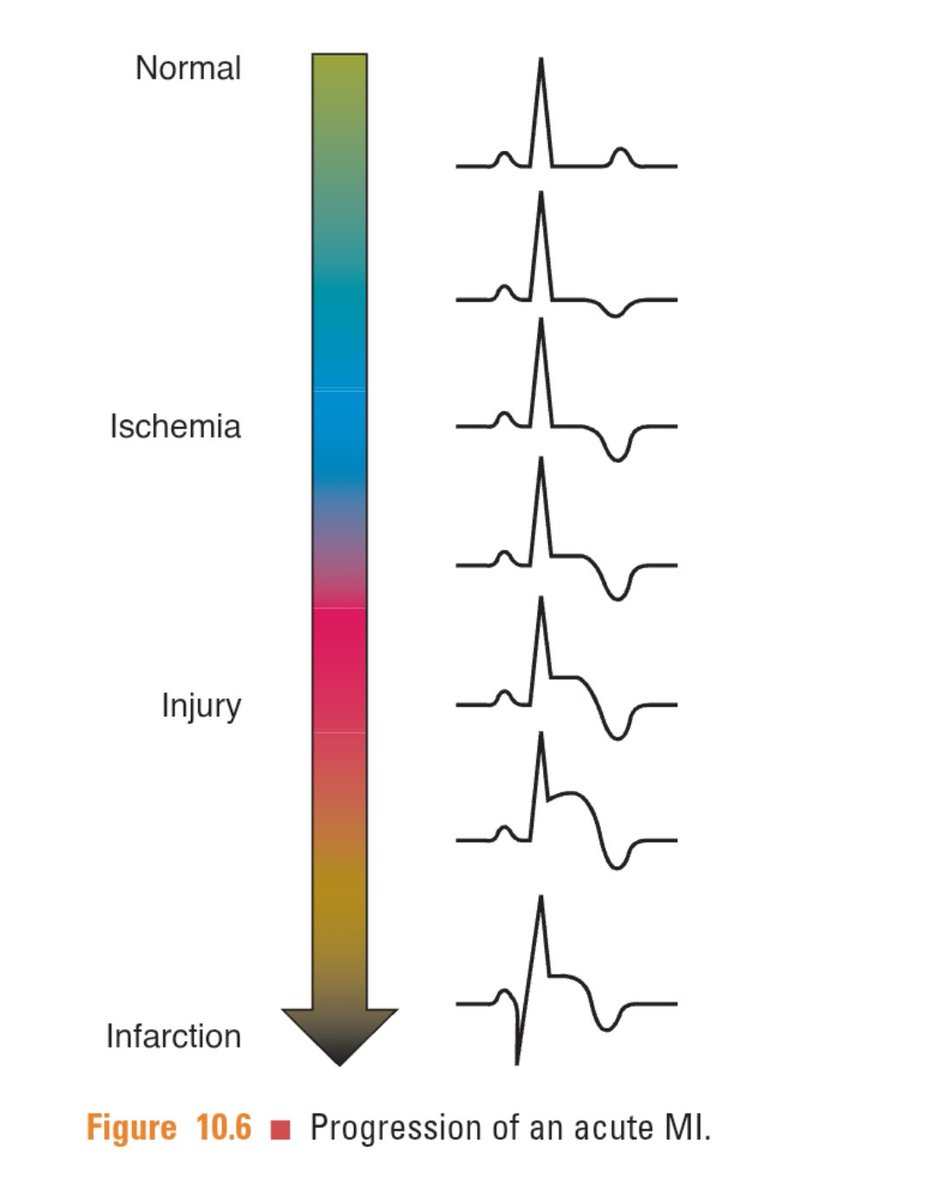 TrackYourHeart's tweet image. Progression of an acute MI