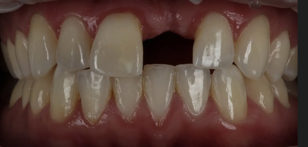 _DocHolliday_'s tweet photo. Elected for Maryland bridge here. Pt had previous graft failure 7 years ago and didn’t want to go thru more surgery. Good friend of mine so told him if pops off more than twice going full coverage. Happy with result. Had been wearing essix’s for 7 years prior 🤯 https://t.co/OMQF7nreKD