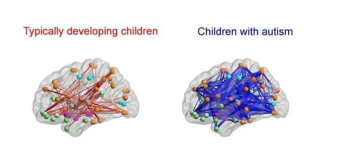 NTFabiano's tweet photo. Children with autism have larger &amp; hyperconnected brains. https://t.co/MvuBuI4Jq2