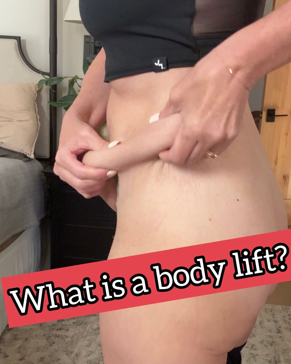gorgeouslyaging's tweet photo. What is a body lift? ⬇️

A body lift is like pulling up your pants bit it’s with your skin around the torso giving your lower body, thighs, and butt a lift, removing loose skin in the process. This is beneficial for aging loose skin or those who have had significant weight loss. A body lift is often done with a tummy tuck. 🫶 #bodylift #tummytuck #bodycontouring #bbl #weightlossjouney #weightloss @estetikinternational