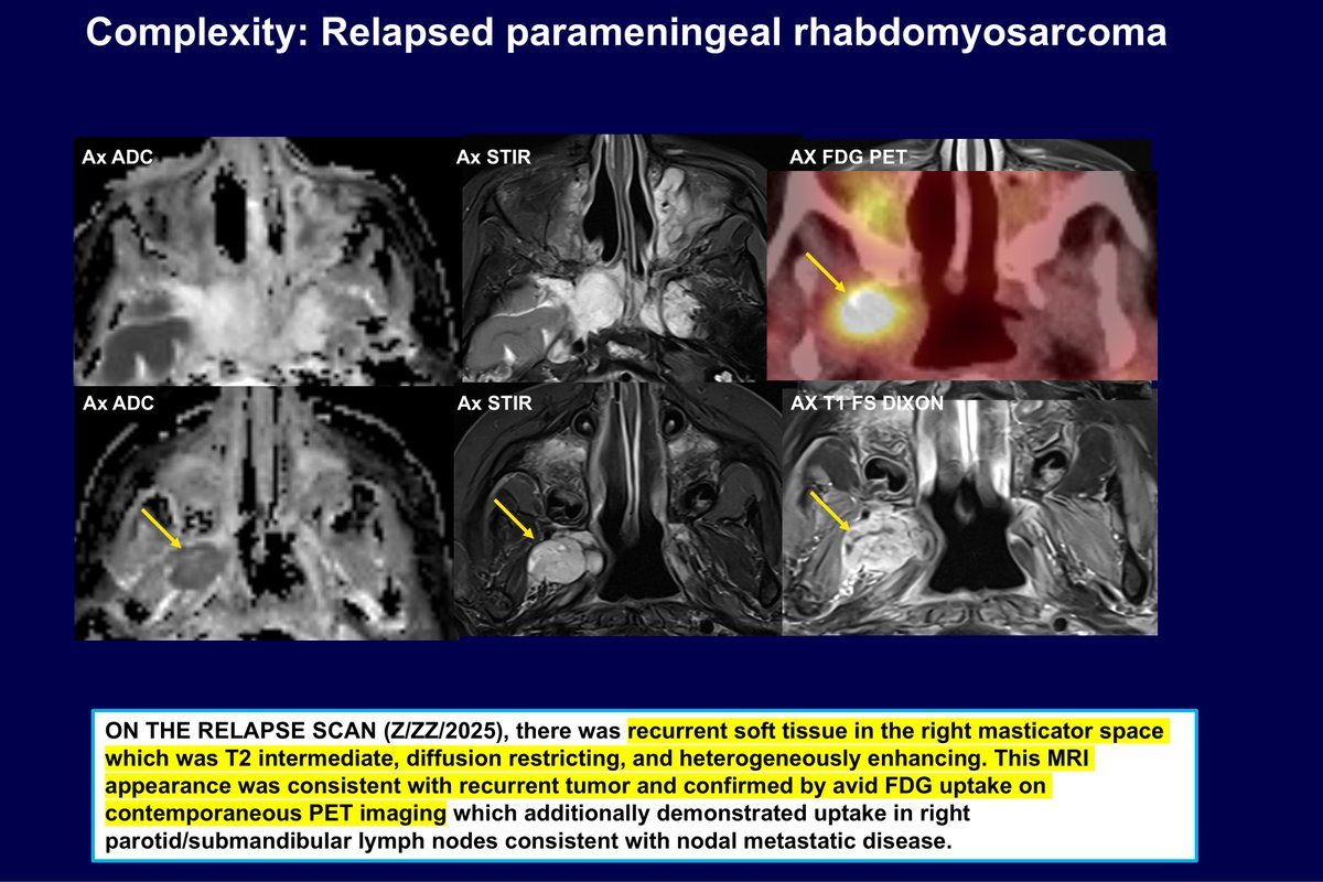 Dr. Edward Yang from <a href="/BostonChildrens/">Boston Children's</a> continues with reporting philosophy, advantages, and disadvantages of structured reporting with great integrative examples!

#ASPNR26 #pedineurorad #PedsRad #MedEd #IPNTN <a href="/spinacademics/">SPIN | Society of Pediatric Neuroimaging</a> <a href="/MirskyDavid/">David Mirsky</a> <a href="/drmankad/">Dr Kish Mankad</a> <a href="/laura1127md/">Laura Hayes</a>