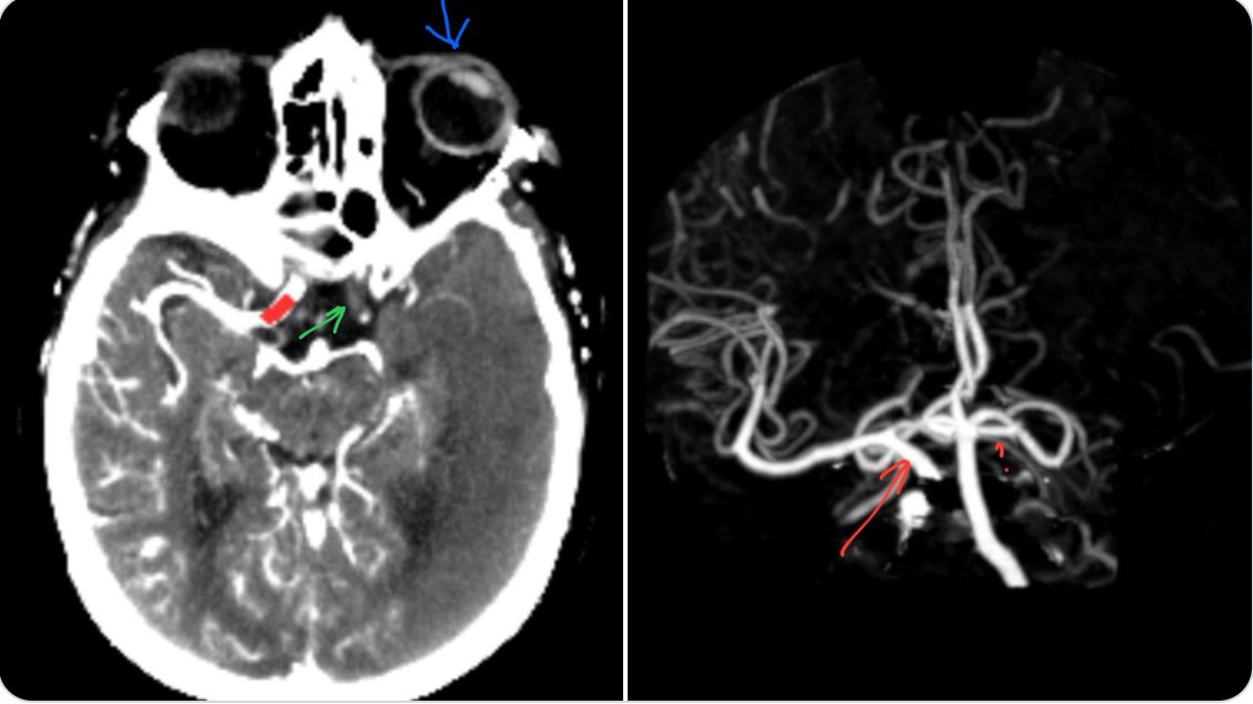 When I look at a CTA, I don't just see pretty pictures—I see physical examination, prognosis, and diagnostic insight.

🧠 This is a left internal carotid artery (ICA) occlusion, likely at the terminus.

🔴 The right intracranial ICA (red arrow) is well-opacified.
❓But on the
