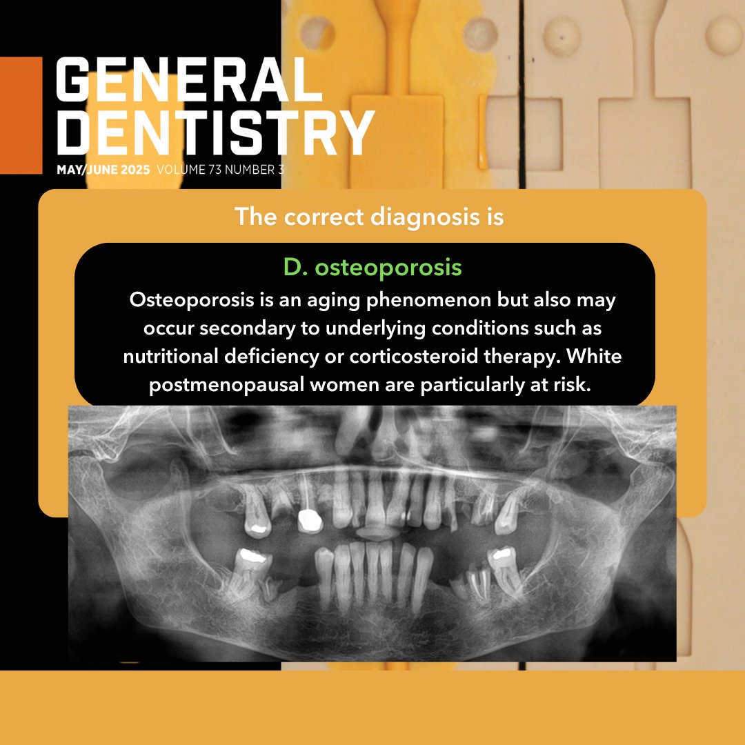 Look for more details in the Oral Diagnosis column in the latest issue of General Dentistry ow.ly/GHnS50W1Vzu