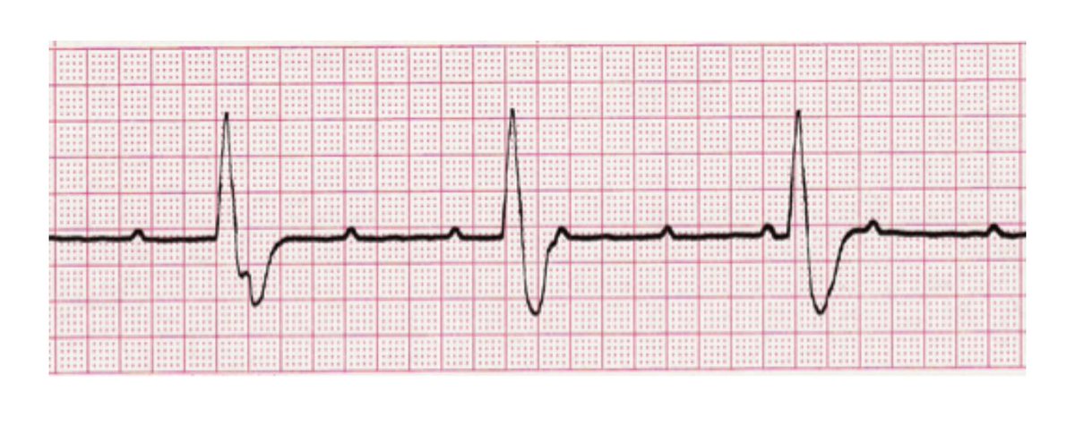تنوم بسبب symptomatic bradycardia 

١) وش التشخيص ؟! 
٢) اذا السبب irreversible، وش الحل ؟!