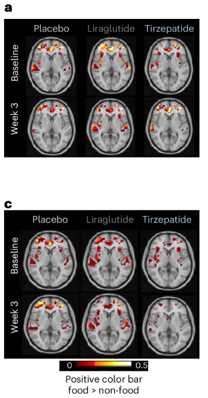 وفقًا لدراسة "Tirzepatide on ingestive behavior in adults with overweight or obesity: a randomized 6-week phase 1 trial"، (عدد المشاركين: 114)، لا يقتصر دور تيرزيباتيد على تقليل الشهية فحسب، بل يُعيد برمجة الدماغ أيضًا. 

📉 النتائج الرئيسية خلال 3-6 أسابيع
🔹 -524 سعرة