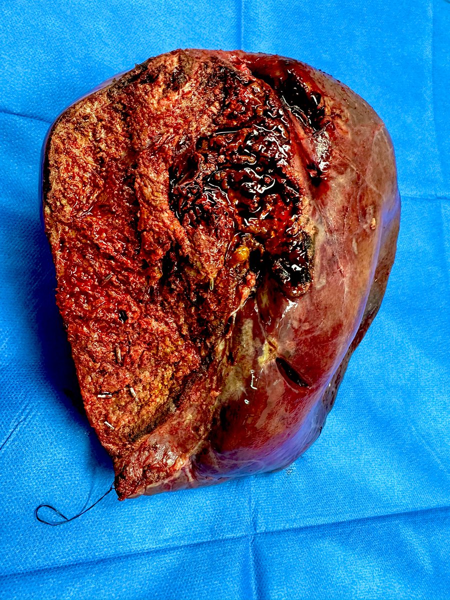 MElprawy's tweet photo. Scrubbing in a case with a fibrolamellar hepatocellular carcinoma ( HCC ) lesion

Perfect surgery day 💪♥️

#HepatoBiliary
#hcc
#liver_surgery https://t.co/xe7DnRLEDA