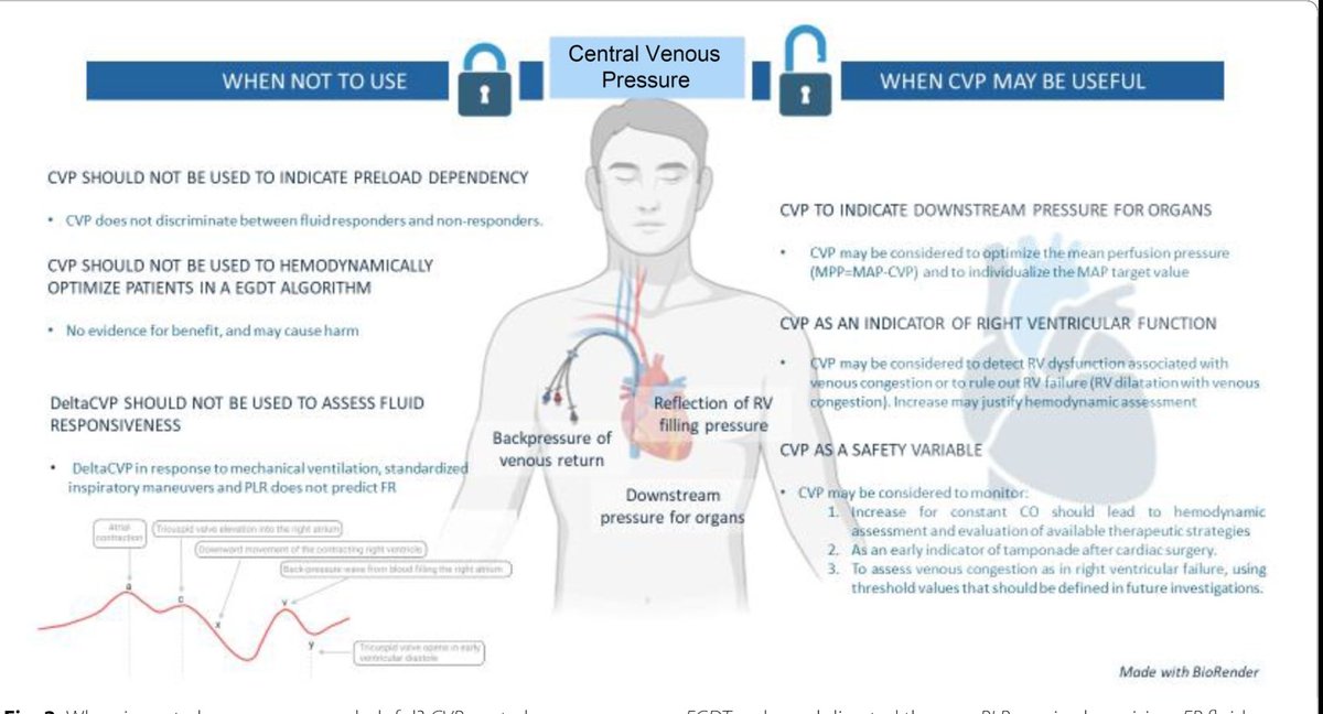drvimalzenICU's tweet image. 🔍 CENTRAL VENOUS PRESSURE: When It Fails, When It Helps
A must read:
Caplan, M., Chew, M.S. & Hamzaoui, O. Central venous pressure: current uses and prospects for an old parameter. Intensive Care Med (2025). doi.org/10.1007/s00134…
#CentralVenousPressure #CVP #Hemodynamics