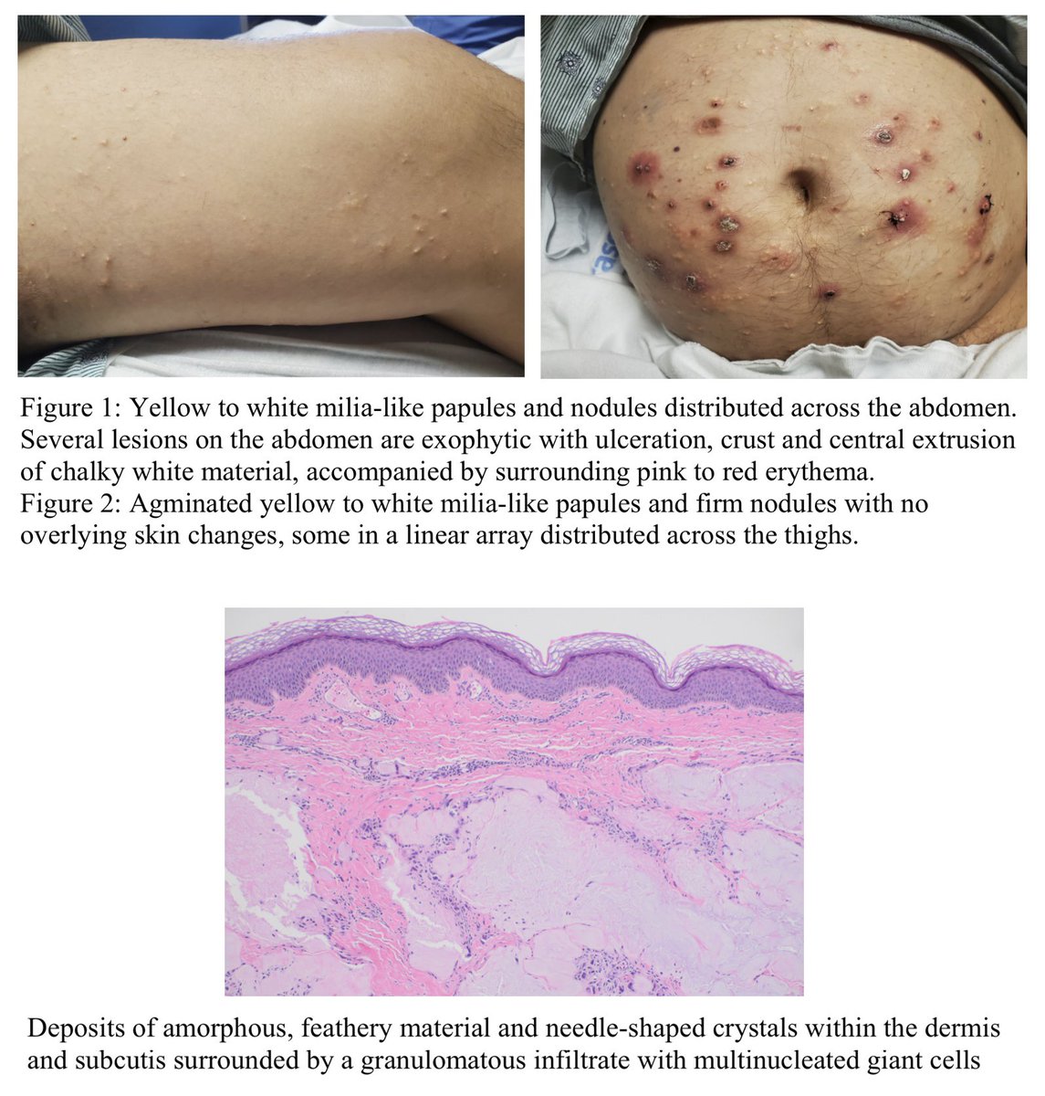 Miliarial #gout is a rare intradermal form of #tophaceous gout (~12 published cases) that presents as small, white, milia-like papules filled with chalky material. It may occur in patients without a prior diagnosis of gout, even as the first sign of tophaceous disease. Unlike