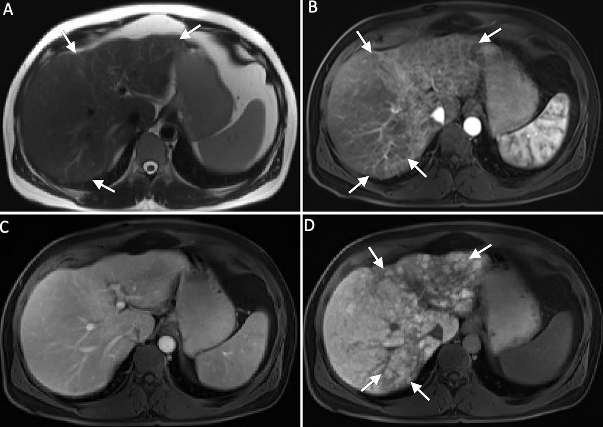 MedBlendPub's tweet image. 🧠 #CaseChallenge
📌 Nodular regenerative hyperplasia mimicking cirrhosis
🔹 Hyperintense subcapsular reticular changes on T2
🔹 AP: hypointense nodules
🔹 PVP: iso-intensity with reticular enhancement
🔹 HBP: nodules = iso- to hyperintense
#LiverImaging #RadRes #MedTwitter