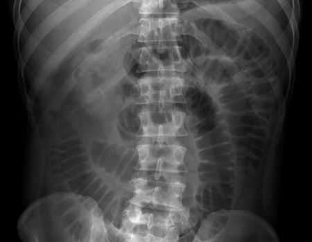 ABDOMINAL X-RAY 2: Patient with history of previous surgery and acute abdominal pain. What does this image show and what is the likely cause? Answer buff.ly/4jxndH1