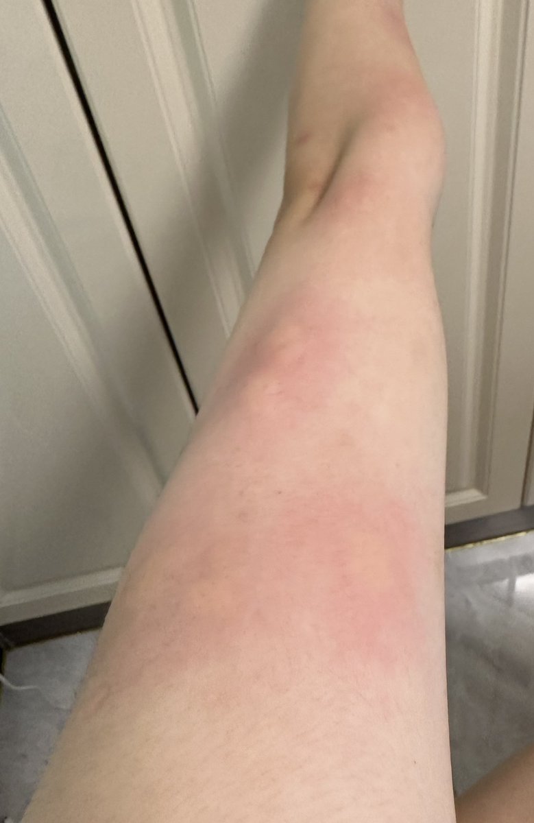 拿了个快递被咬了14个包，我真是杀了你德玛傻逼蚊子