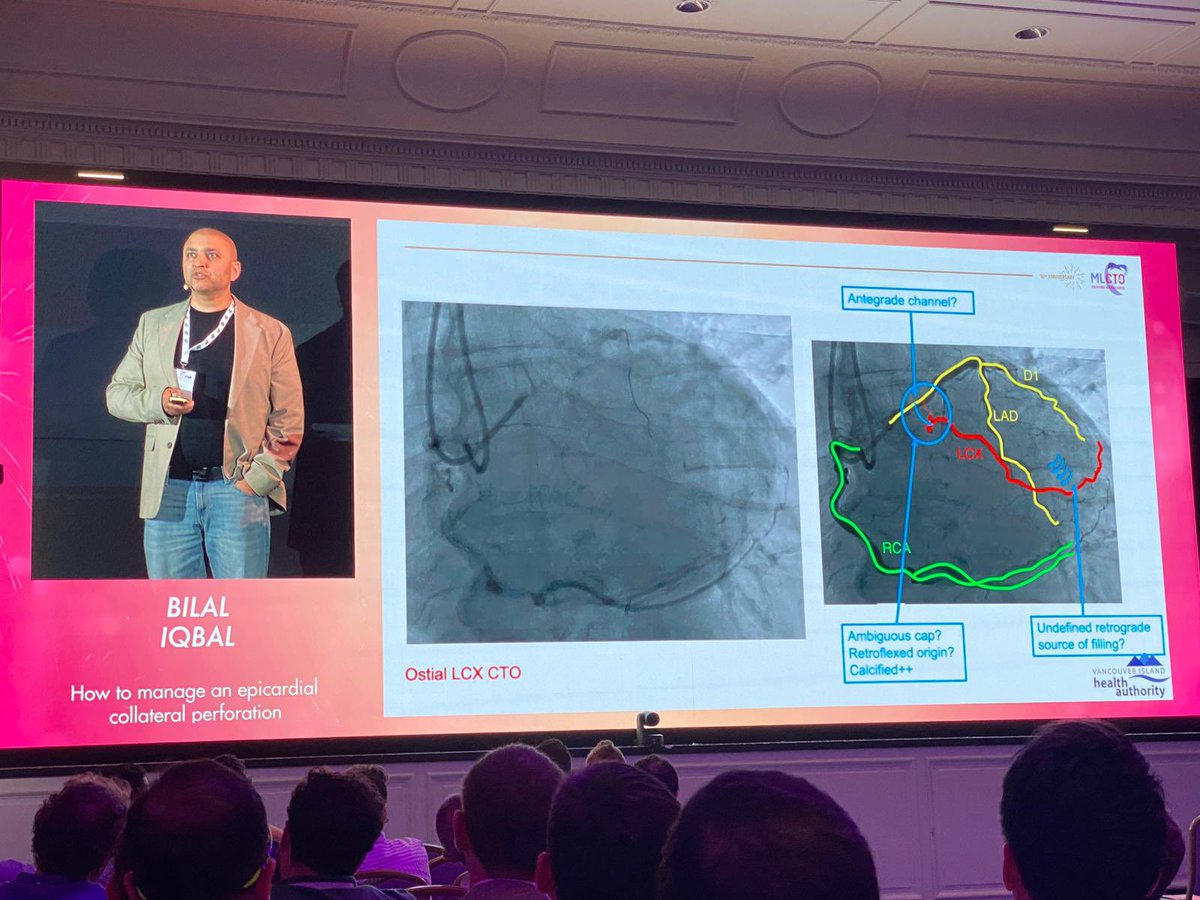 Great honour to participate in the 10th Anniversary of MLCTO meeting in Nice, France! I was able to share my experiences and deliver a talk on managing epicardial collateral perforations. MLCTO serves to be an exceptional meeting in an exceptional location delivering exceptional