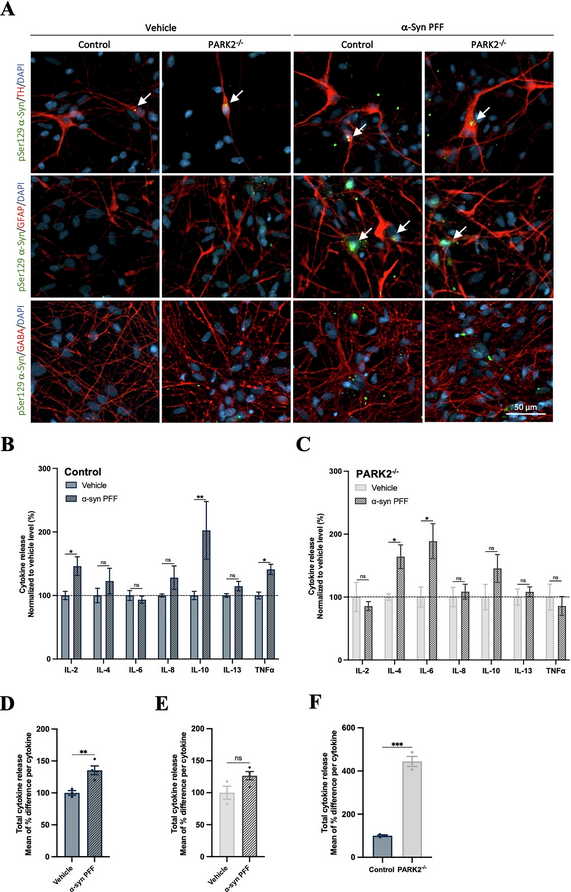 ScienceofPD's tweet photo. Using human isogenic PARK2−/− induced pluripotent stem cell-derived neurons, researchers report the formation of seeding-competent α-synuclein aggregates; Challenging the view of PARK2-related #Parkinsons as a non-synucleinopathy
https://t.co/EPD5qZKTgx https://t.co/4OjpumhGxl