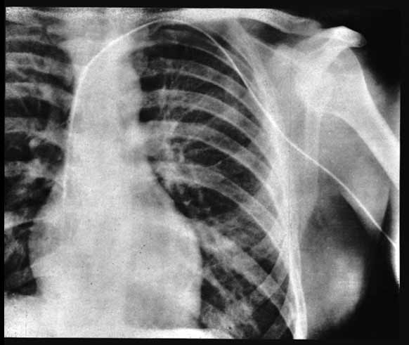 At the age of 24, Werner Forssmann had a plan - to try the very first heart catheterisation on himself. 

Catheterisation is today a common procedure used to find heart defects, deliver medicine and open up blocked arteries. In 1956, Forssmann shared the medicine prize.