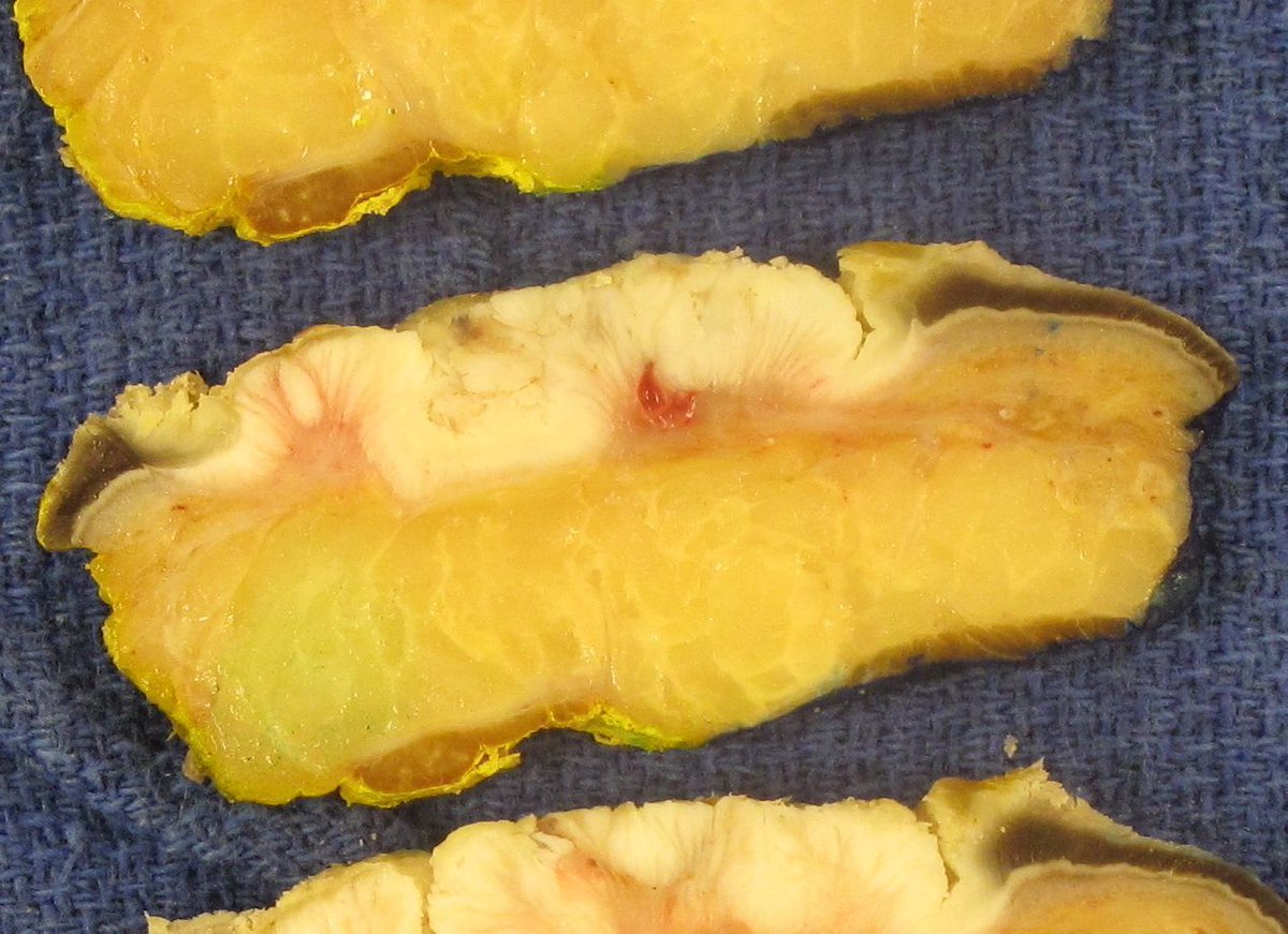 JMGardnerMD's tweet image. 50 M. Large plaque plantar foot. What’s your #grosspath diagnosis? 
Digital slide: kikoxp.com/posts/7010. 
Answer ✅ youtu.be/fo67KS6wHjA?si…
Sample #pathology report: kikoxp.com/posts/8404. #pathologists #pathTwitter #dermpath #dermatology #dermtwitter