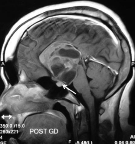 🙆‍♀️ 25-year-old woman with 2-month history of headache, vomiting, and visual blurring. MRI reveals a suprasellar mass.

🤔What’s your differential diagnosis?