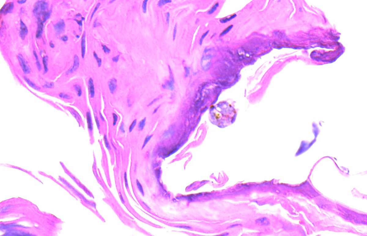 Play the Hi - Lo game... what's the diagnosis based on the hi mag pic?  Then see the wsi to see if you're right... kikoxp.com/posts/60070