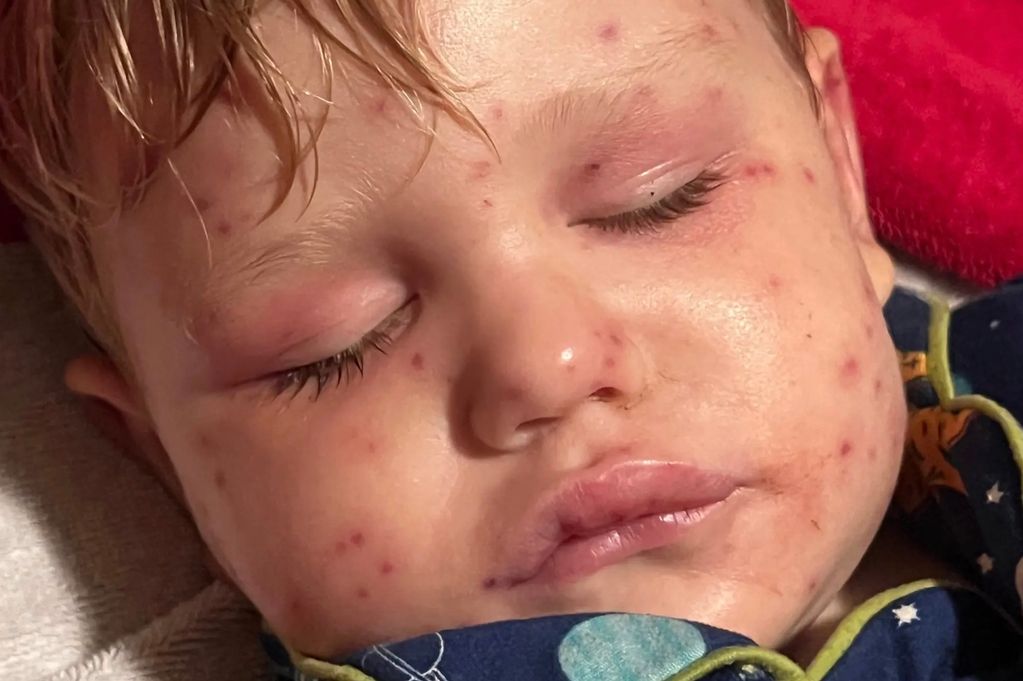 An absolutely horrible accident happened in rural Georgia when 2-year-old Beckham Reed was riding a toy car around his home when he hit a nest of yellow jacket wasps which stung the baby over 150 times they found out in the ER. He was given morphine and Benadryl and sent home.
