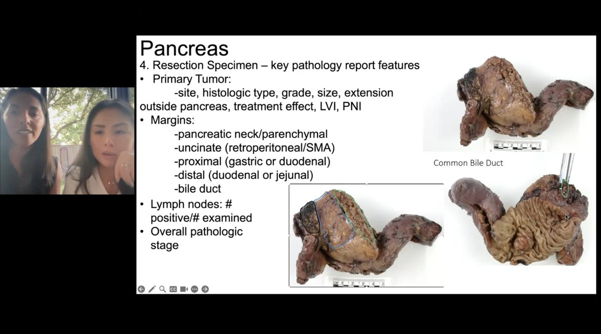 Dr. Nina Niu Sanford (@niusanford) on Twitter photo After a brief hiatus, we are back w the teaching videos!
Just recorded GI pathology 101 series w our awesome chief of GI pathology, <a href="/SuntreaHammer/">Suntrea Hammer</a>.
Going to edit etc & share soon. After a brief hiatus, we are back w the teaching videos!
Just recorded GI pathology 101 series w our awesome chief of GI pathology, <a href="/SuntreaHammer/">Suntrea Hammer</a>.
Going to edit etc & share soon.