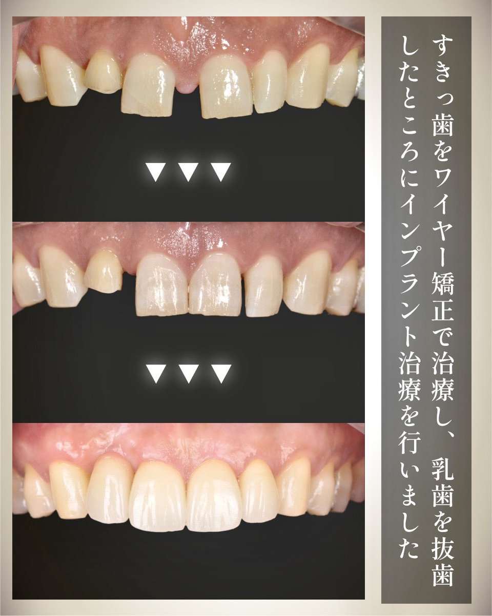 ♡裁断済 虫歯思いの歯科矯正治療 すきっ歯 - অনুসন্ধান / X