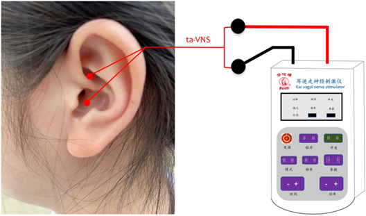 terapiamanualUE's tweet photo. ESTIMULACIÓN ELÉCTRICA TRANSCUTÁNEA DE LA RAMA AURICULAR DEL NERVIO VAGO 

La estimulación eléctrica transcutánea del nervio vago auricular (taVNS) es una terapia no invasiva que modula la fisiología cerebral mediante la estimulación eléctrica de la rama auricular del nervio vago https://t.co/L9WGiDZ4z7