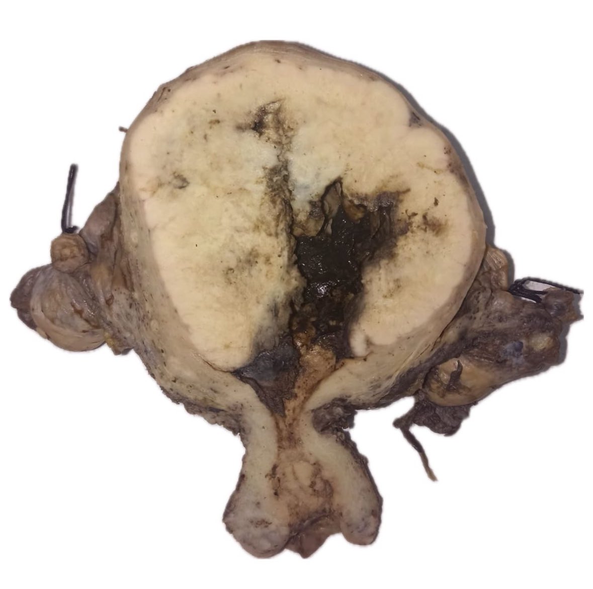 The art of grossing.A 69 yo woman with postmenopausal bleeding. Final Diagnosis. Endometriod Carcinoma FIGO grade 3.( 8x6x3cm). #pathologists #pathresidents #pathTweeter #GYNpath ⁦<a href="/SLAPpatologia/">SLAP Patología</a>⁩