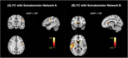 Téngase fino que esté #Preprint revela el porque de síntomas conductuales prevalentes, como fatiga, deterioro de la memoria, déficit de atención e insomnio en pacientes "recuperados de #COVID_19"
#LongCovid

76 pacientes recuperados (PCR) de #COVID19  vs 51 controles sanos (CN)
